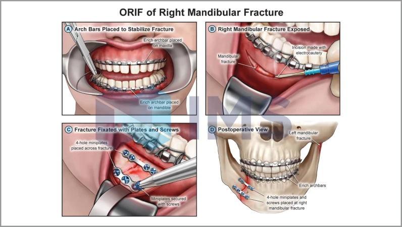 Medical Demonstratives 01_ORIF