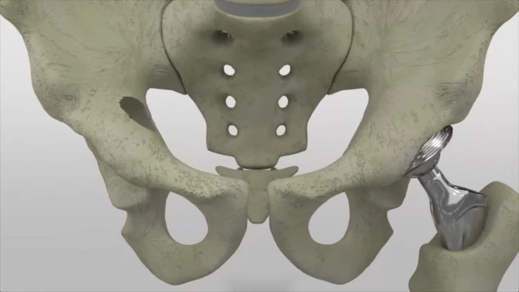 9_Hip_Replacement_Clipped_thumbnail