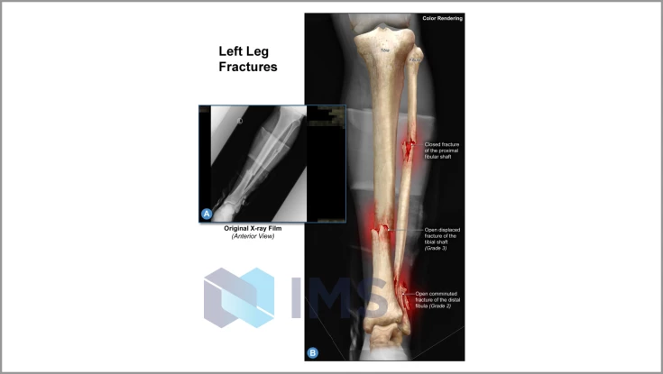 Medical Demonstratives_7_Leg Fractures
