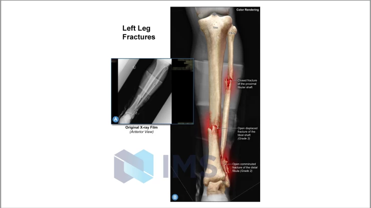 Medical Demonstratives_7_Leg Fractures