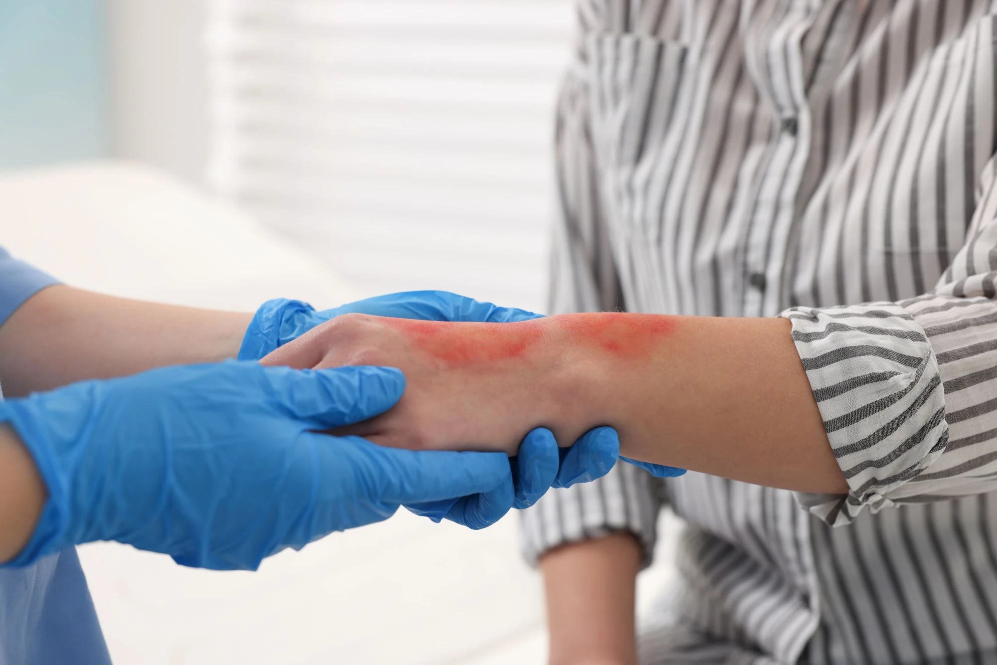 Burn Injuries Back Image Holistic Life Care Planning for Burn Injury Survivors | IMS Legal ...