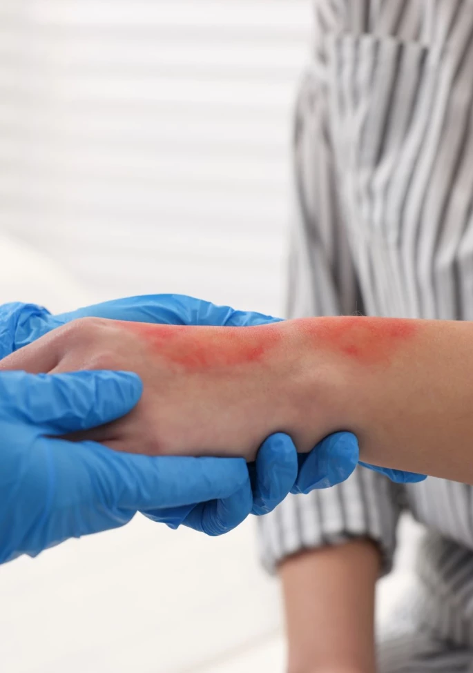 Holistic Burn Injury