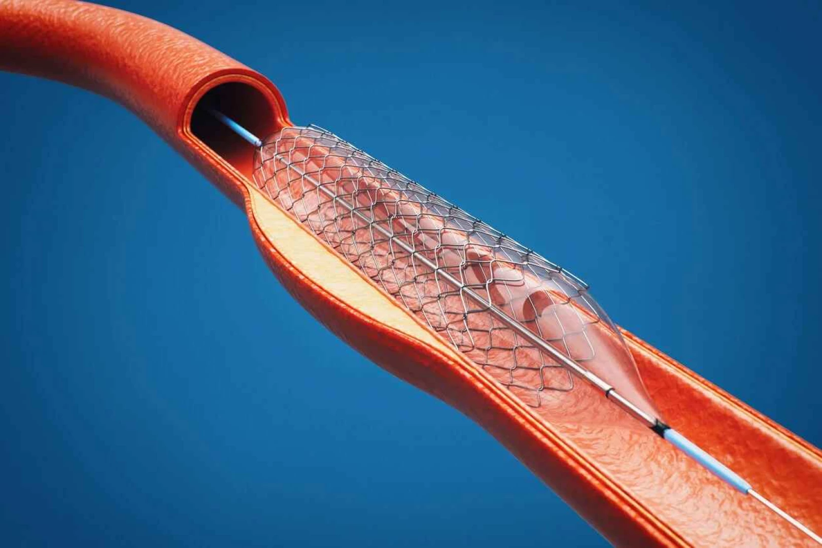 Close-up of a medical tube, demonstrating medical equipment in San Jose, CA by IMS Legal